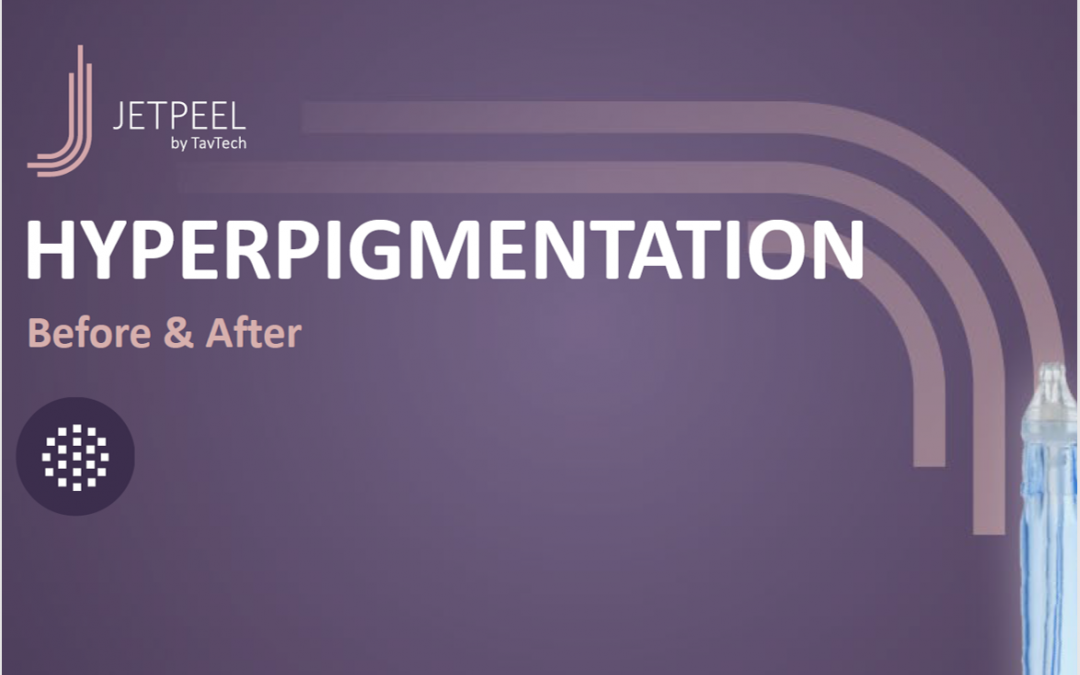 Hyperpigmentation Treatments B&A