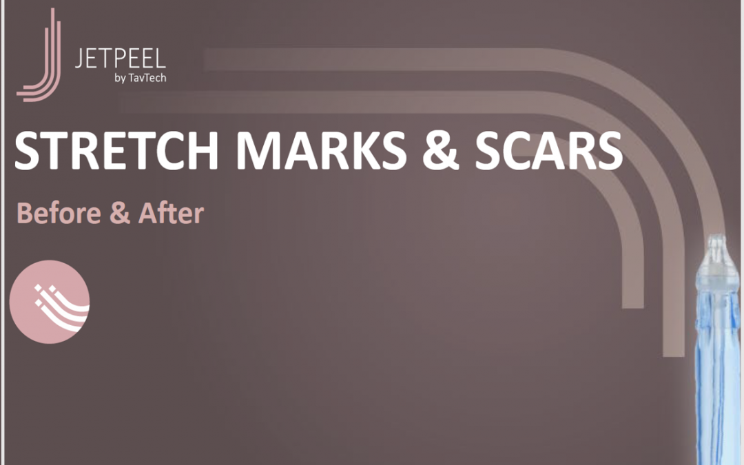 Stretch Marks & Scars B&A