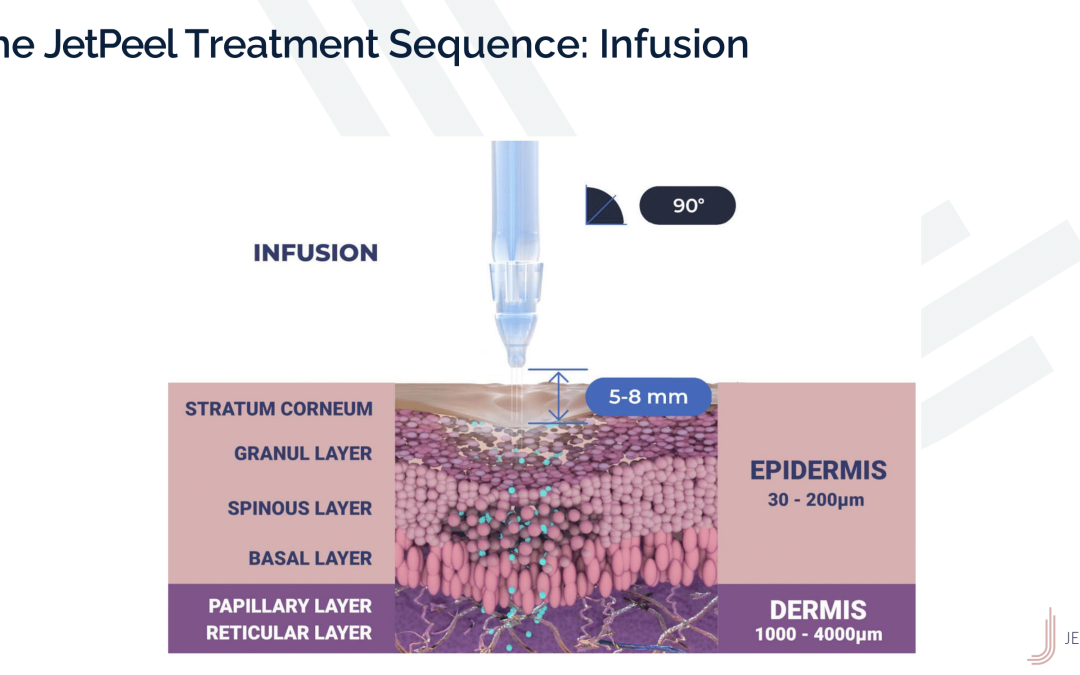 JetPeel Treatment Sequence – Infusion 1