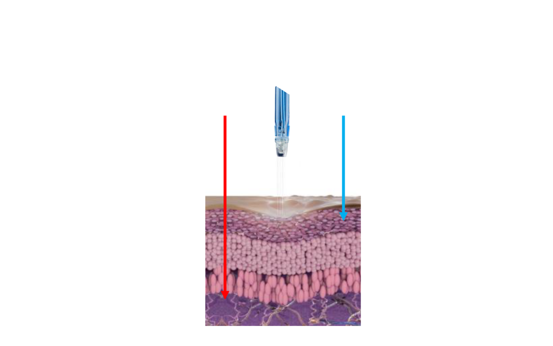 JetPeel non-Sterile Handpiece with LED Boost 1