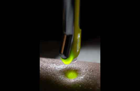 Jet-LED Yellow-Green simultaneous treatment close-up