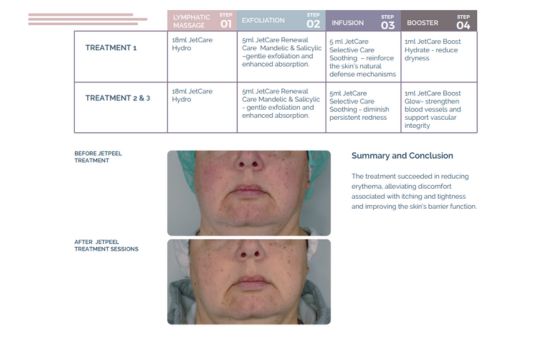 Facial Erythema Therapy – Dr. Wiktoria Odrzywołek