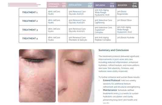 Post-Acne Scarring – Laura Masini