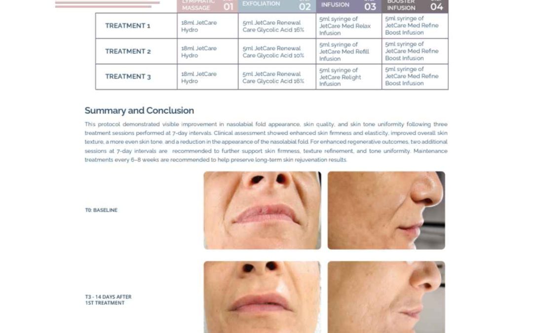 Nasolabial Fold and Skin Tone Improvement
