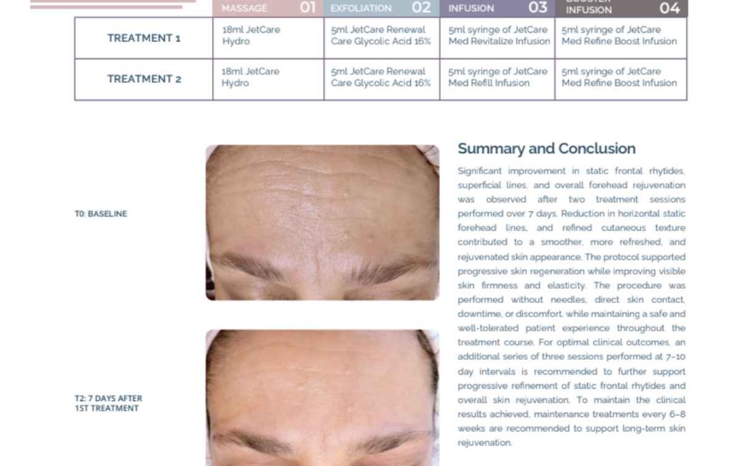 Static Frontal Rhytides Refinement and Skin Rejuvenation
